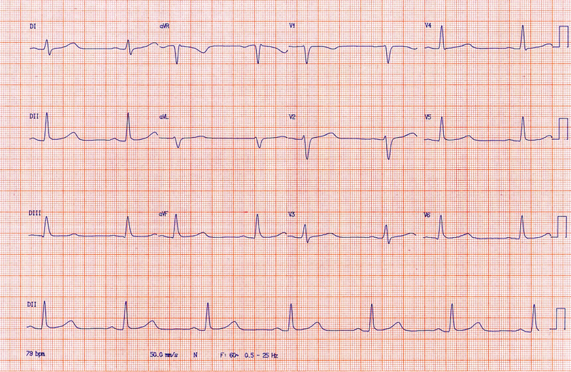 Clínica Taboinha - Eletrocardiograma